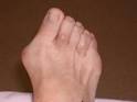 Bunion Image