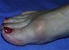 Hallux Rigidus Image